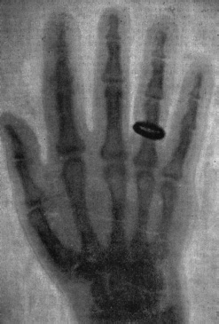 Start of image description, An X-ray image of Anna Bertha Ludwig&rsquo;s hand published by her husband, Wilhelm R&ouml;ntgen, on 22 December 1895. The hazy image shows the bones of her left hand and her wedding ring., end of image description